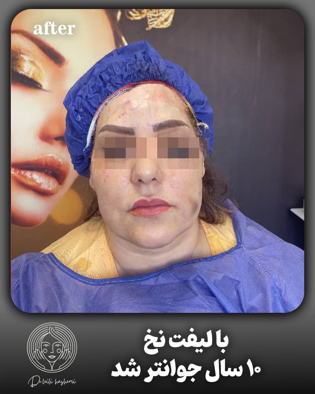 لیفت با نخ در تهران