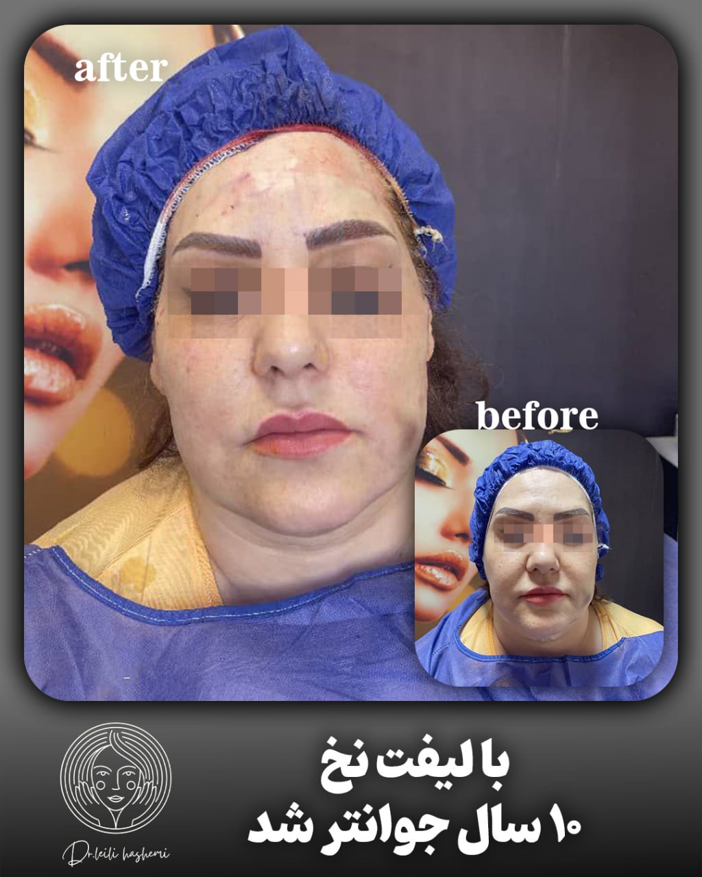 لیفت صورت با نخ در تهران