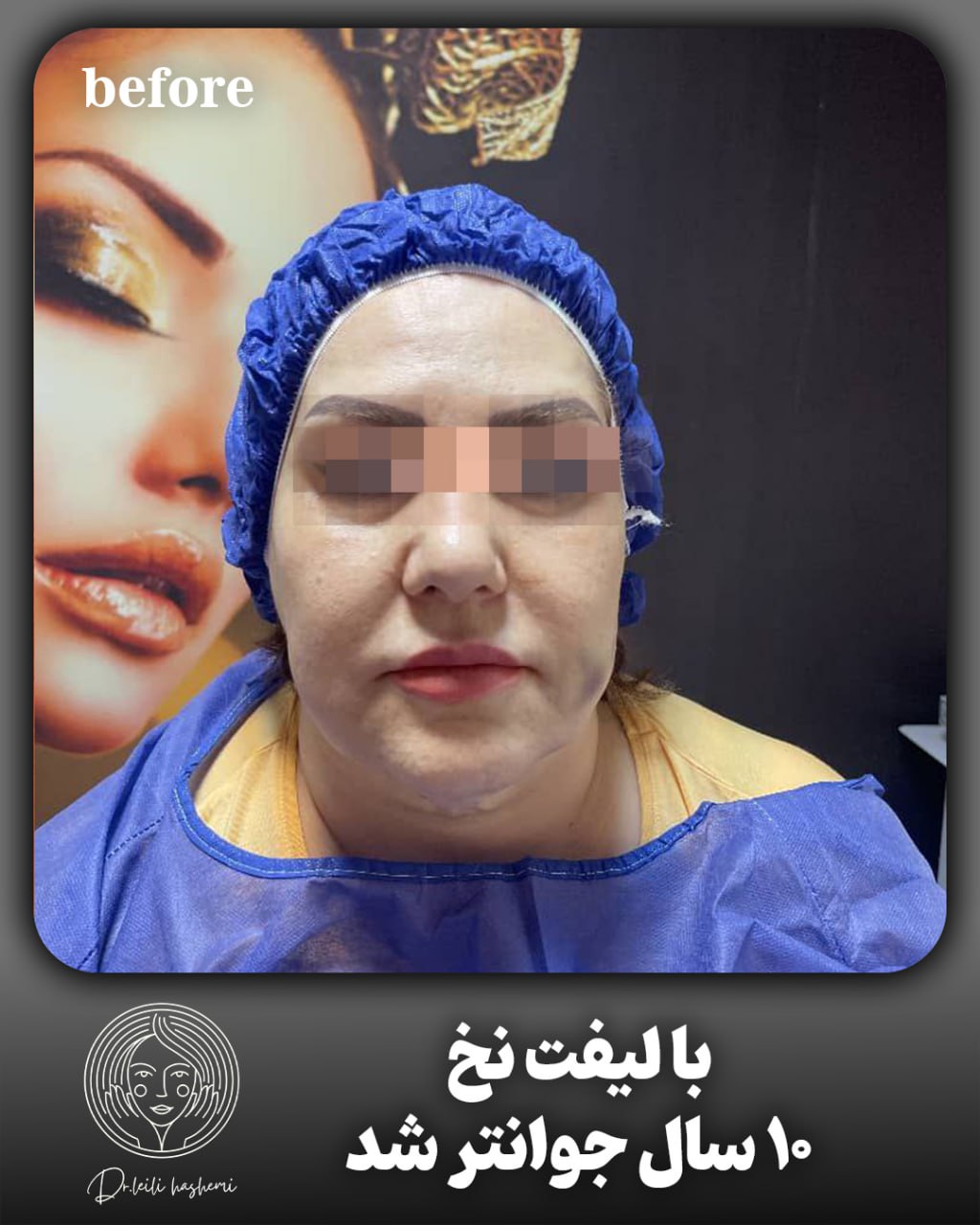 لیفت با نخ در تهران در کلینیک دکتر هاشمی