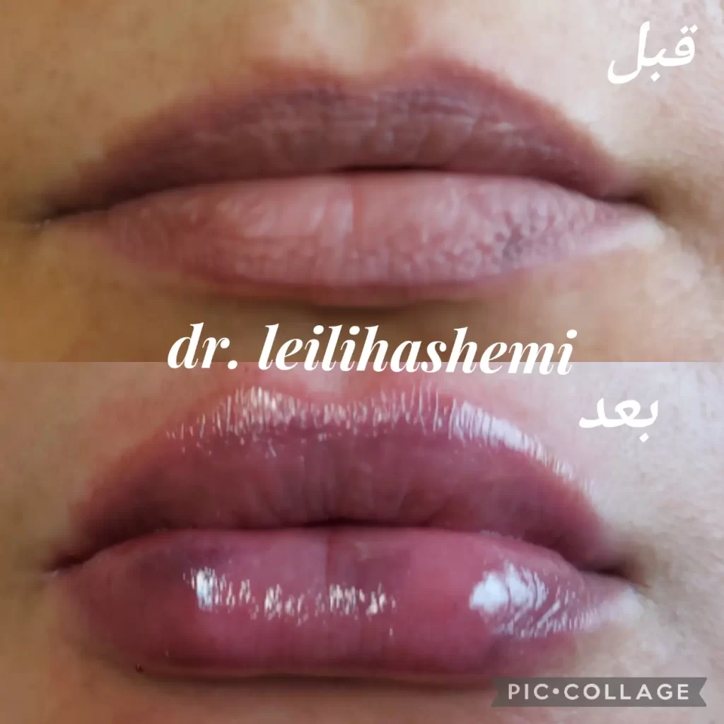 عکس پروتز لب چاکدار