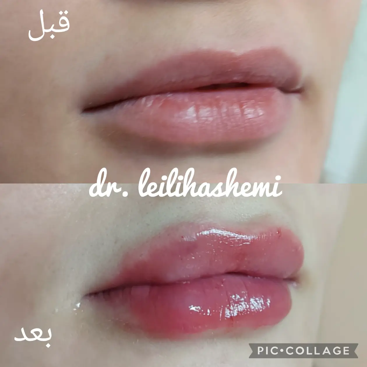 عکس پروتز لب عروسکی - عکس پروتز لب باربی