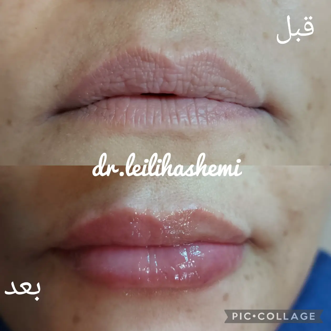 عکس قبل و بعد تزریق ژل لب در کلینیک دکتر لیلی هاشمی (6)