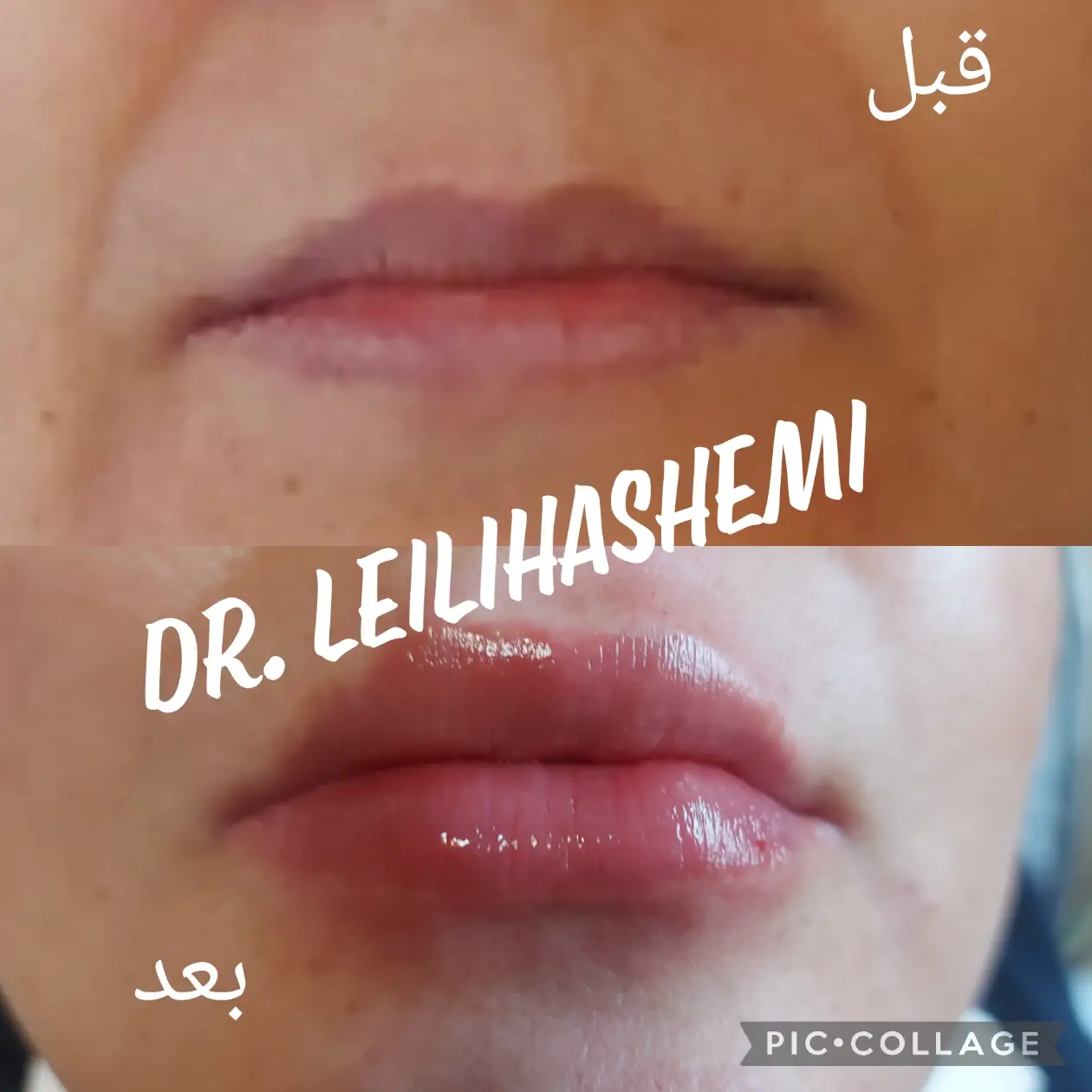 عکس قبل و بعد تزریق ژل لب در کلینیک دکتر لیلی هاشمی (7)