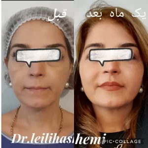 عکس تزریق چربی به صورت و گونه