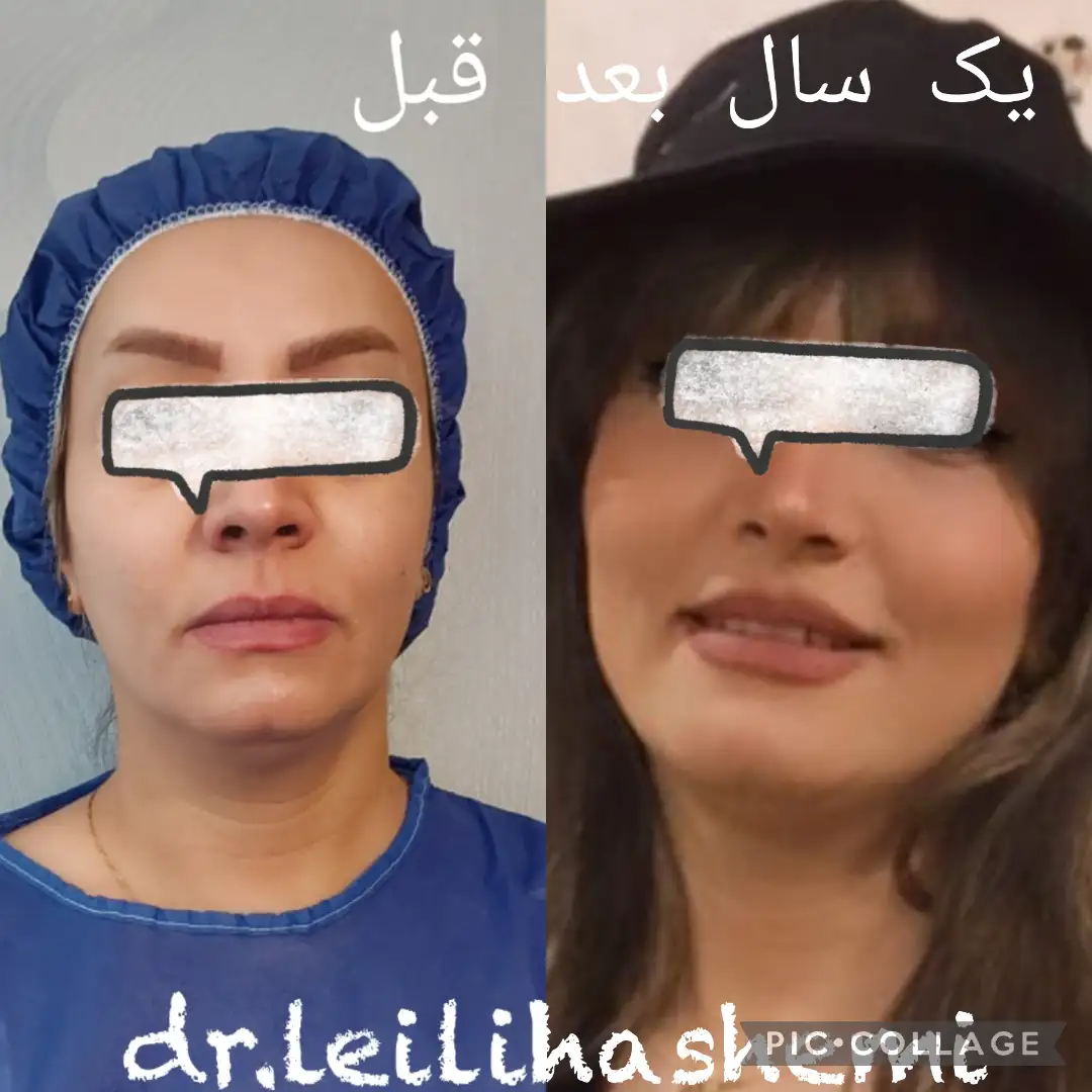 عکس بعد از تزریق چربی به صورت با رعایت کردن نحوه شستن صورت بعد از تزریق چربی