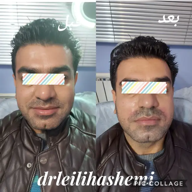 چند روز بعد از تزریق چربی صورت طبیعی میشود؟