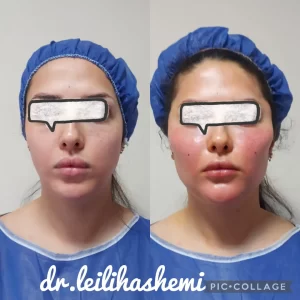 عکس تزریق چربی به صورت - دکتر لیلی هاشمی