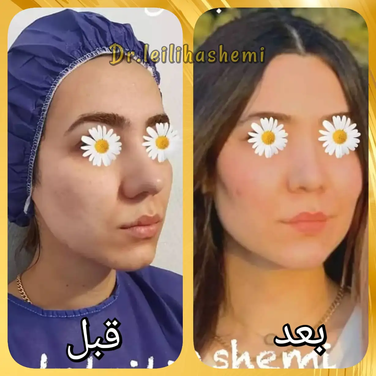 عکس تزریق چربی به صورت در کلینیک دکتر لیلی هاشمی