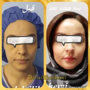 نمونه کار تزریق چربی دکتر لیلی هاشمی
