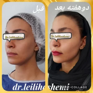 عکس صورت طبیعی بعد از تزریق چربی - دکتر لیلی هاشمی