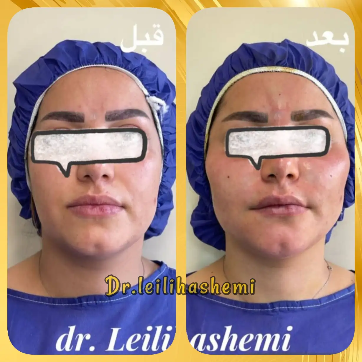 نمونه کار تزریق چربی در کلینیک دکتر لیلی هاشمی