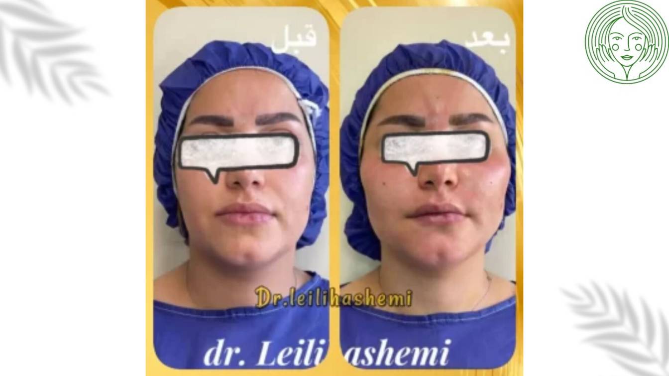 زیباجو متقاضی تزریق چربی؛ بلافاصله بعد از تزریق توسط دکتر لیلی هاشمی