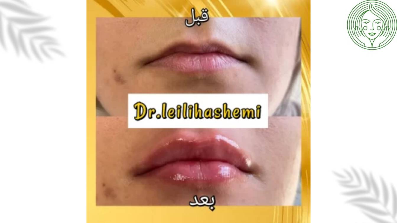 عکس قبل و بعداز تزریق چربی به لب 