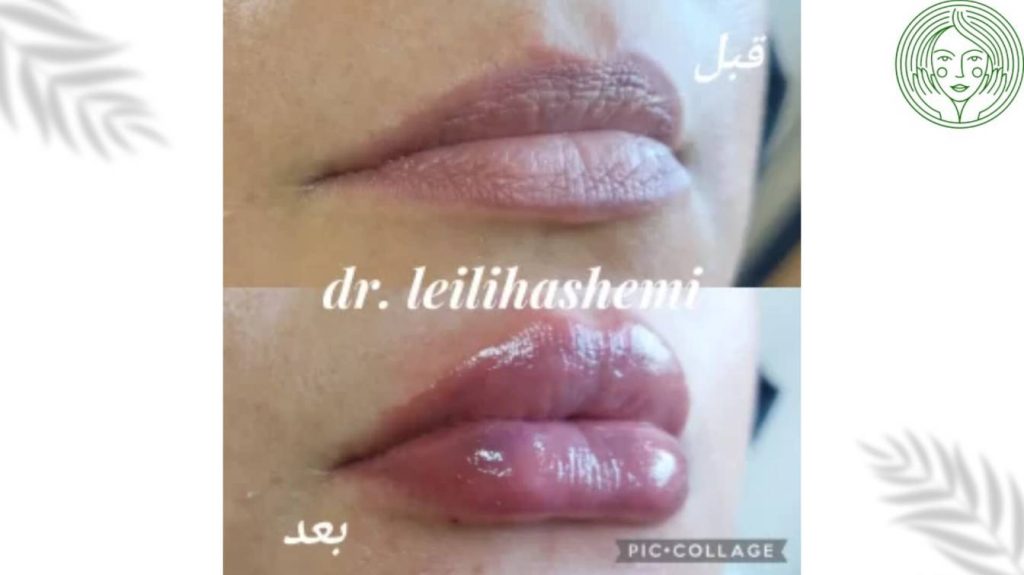 عکس پروتز لب قلبی