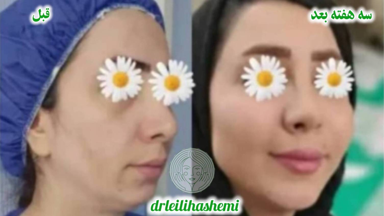 تزریق فیلر چانه جهت زاویه بهتر فک و چانه