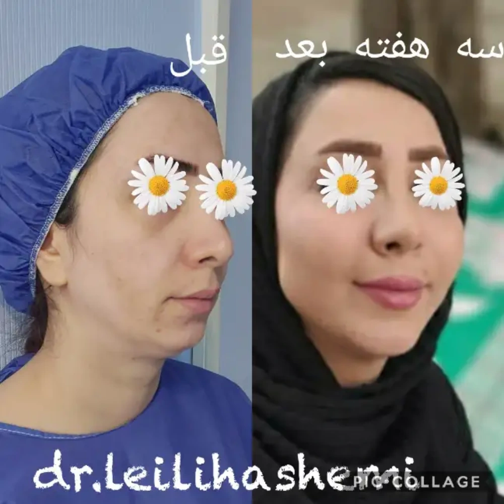 تزریق چربی‌ به صورت لاغر چه مزیت‌هایی دارد؟