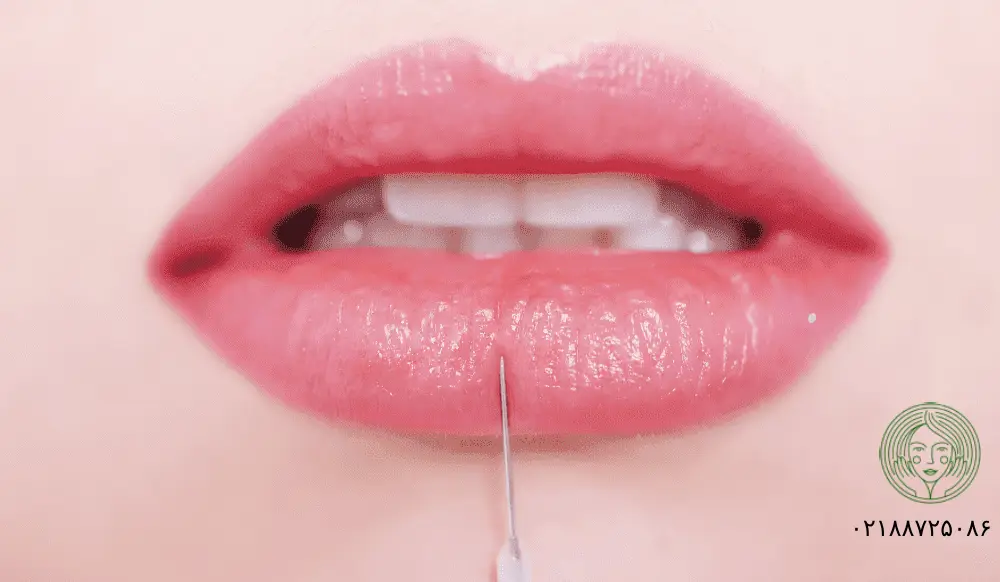 تزریق چربی به لب