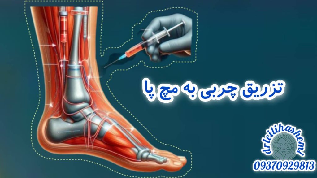 تزریق چربی به مچ پا