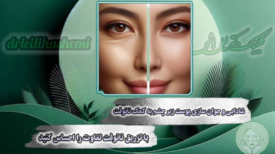 رفع گودی زیر چشم با تزریق نانوفت زیر چشم