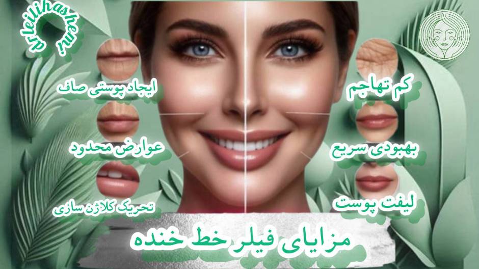 مزایای فیلر خط خنده چیست؟