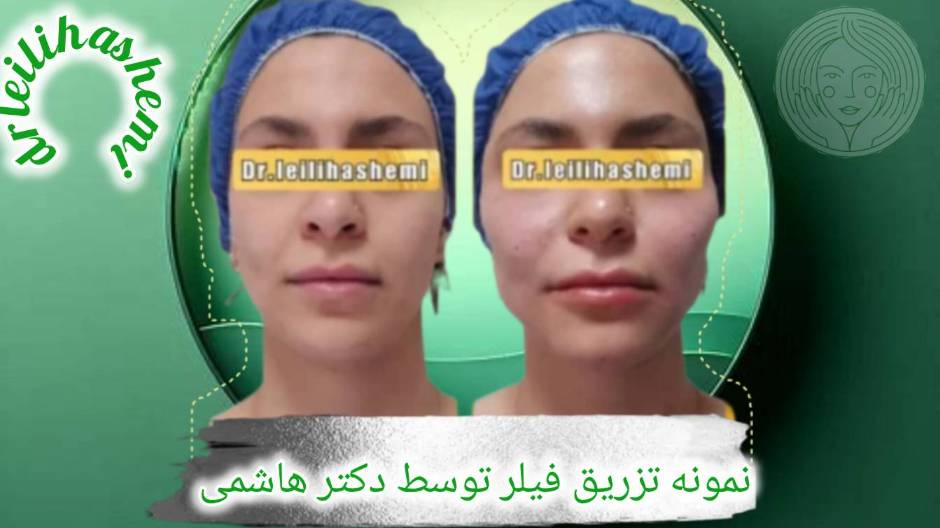 نمونه کار تزریق دکتر هاشمی