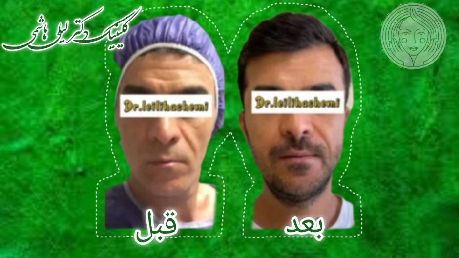 نمونه کار دکتر هاشمی؛ تزریق پیشانی