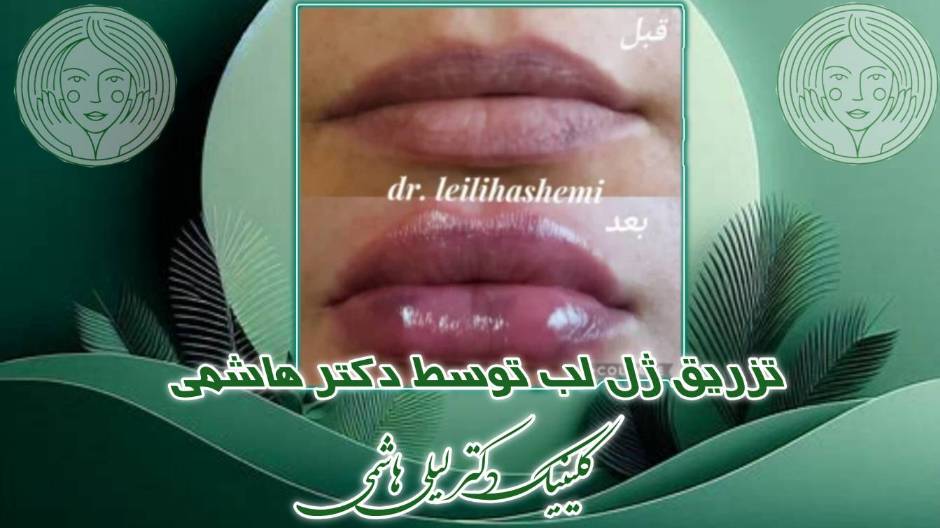 مراقبت بعد از ژل لب را جدی بگیرید.