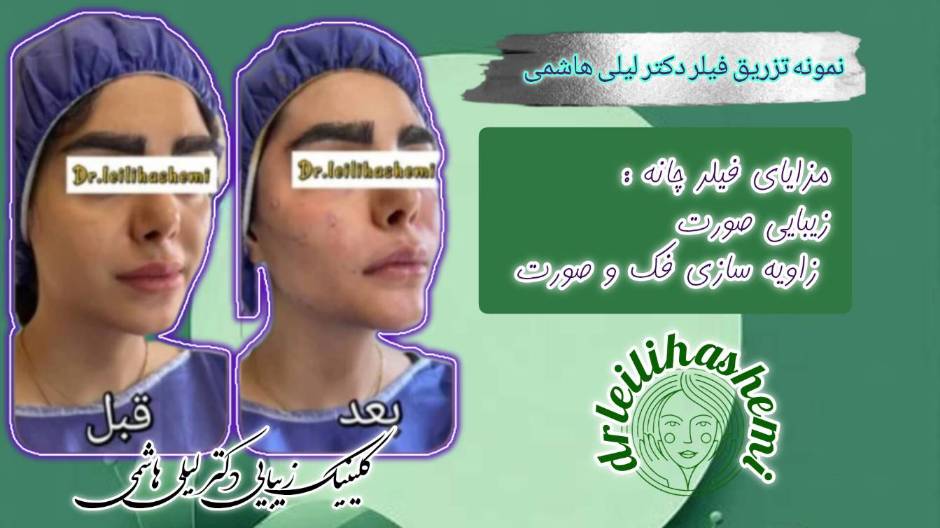 نمونه کار فیلر صورت توسط دکتر هاشمی