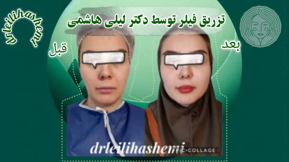تزریق فیلر صورت راهی تضمینی برای جوانسازی پوست
