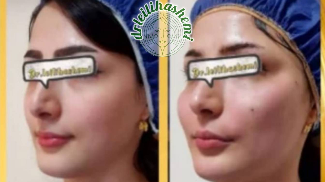 انواع روش تزریق چربی بهصورت