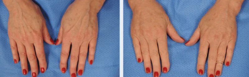 عوارض تزریق چربی به دست