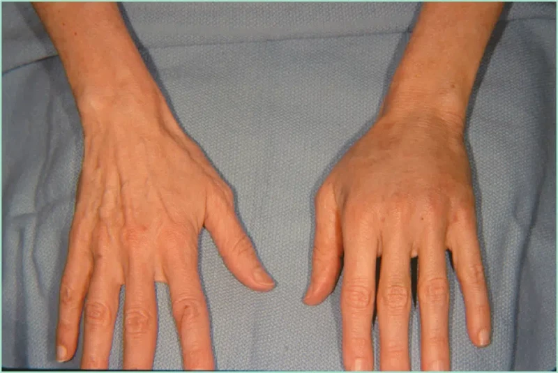 مزایای تزریق چربی به دست