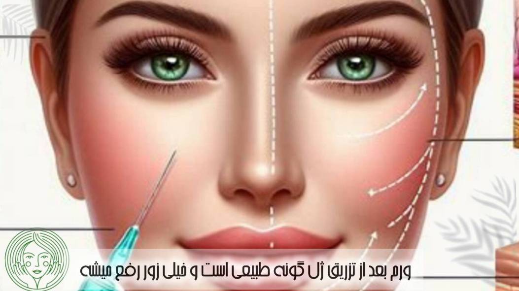 بین 3 تا 5 روز ورم بعد از تزریق ژل گونه رفع میشه و جای نگرانی نیست.ورم بعد از تزریق ژل گونه چند وز طول میکشد؟