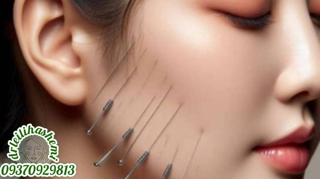 لیفت صورت با نخ