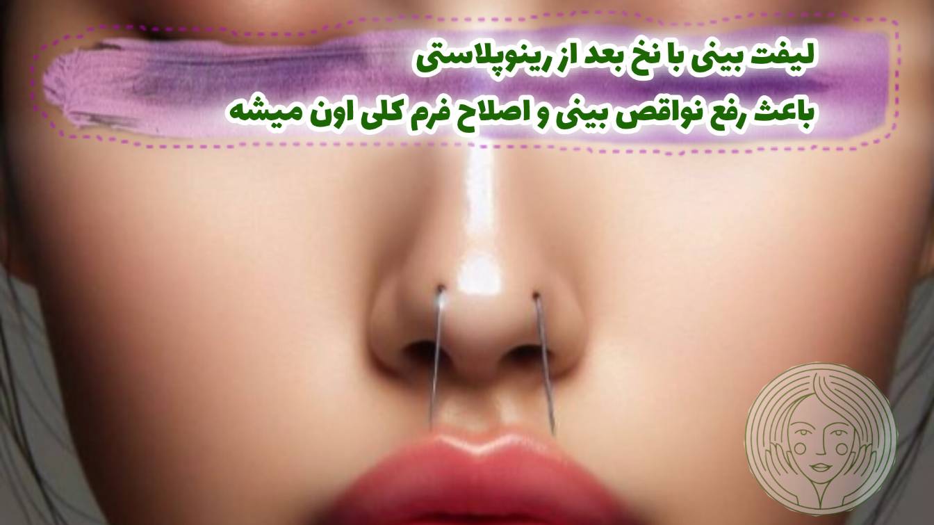 لیفت بینی با نخ و ویژگی های آن