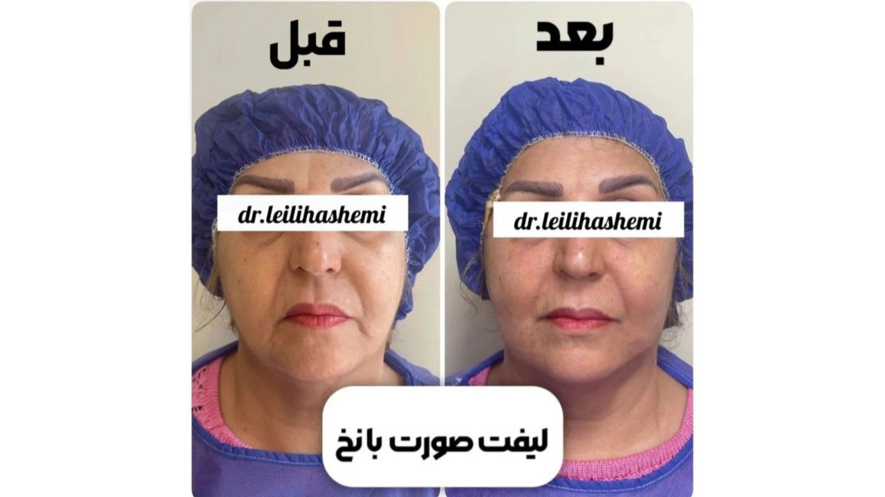 عکس قبل و بعد لیفت صورت با نخ