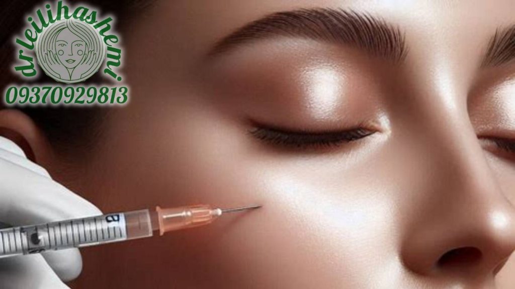 مواضع تزریق ژل صورت