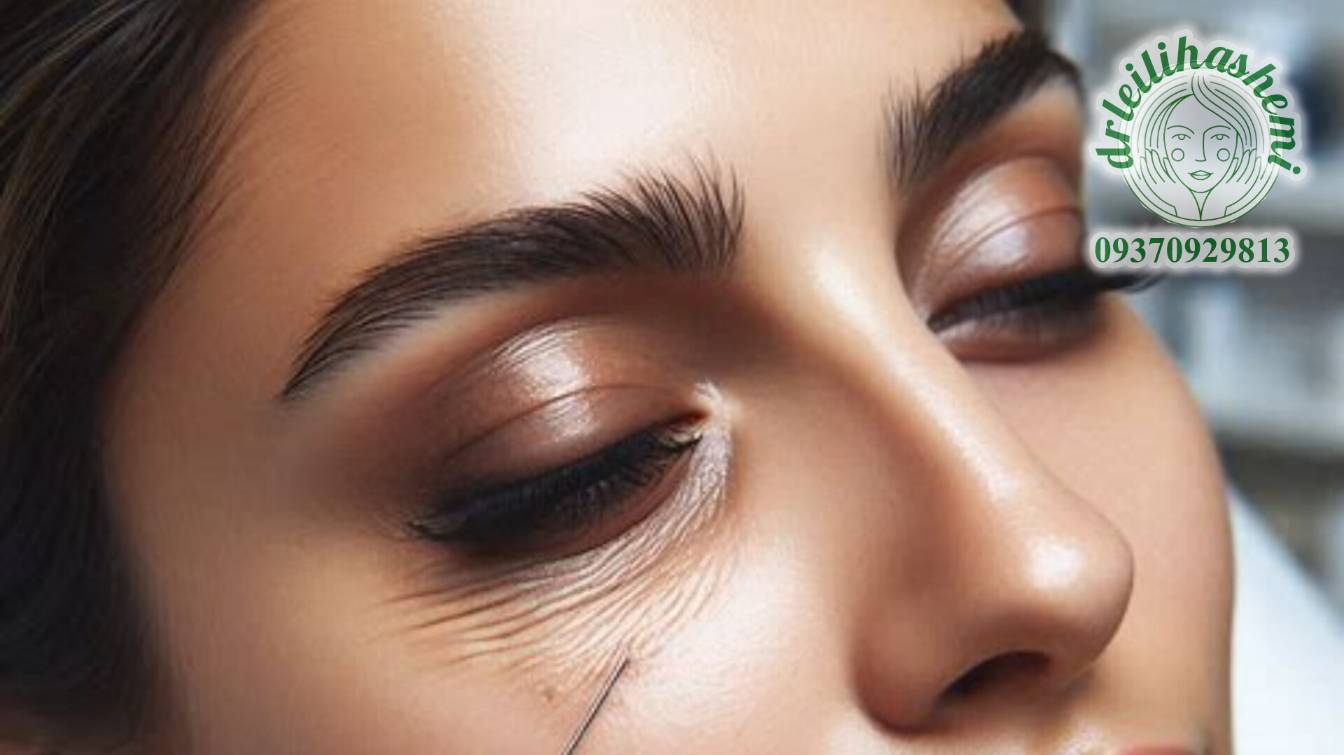 مزوتراپی زیر چشم