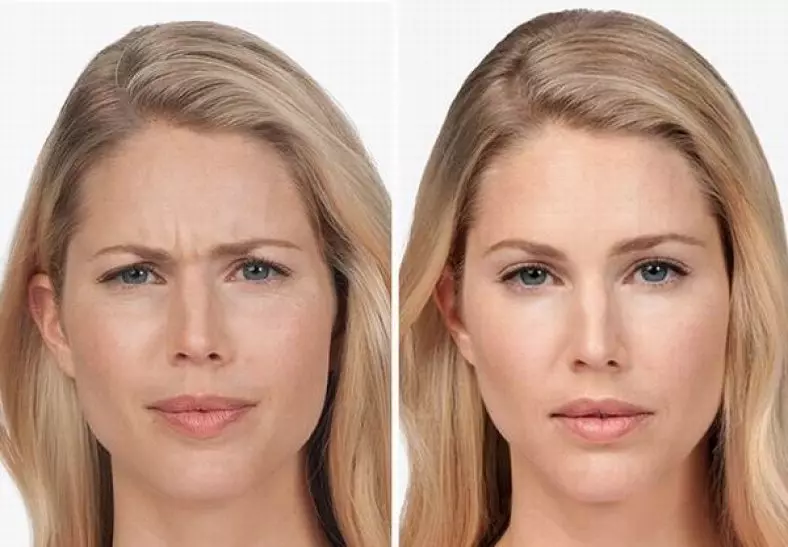 عوارض بوتاکس پیشانی و دورچشم و ابرو