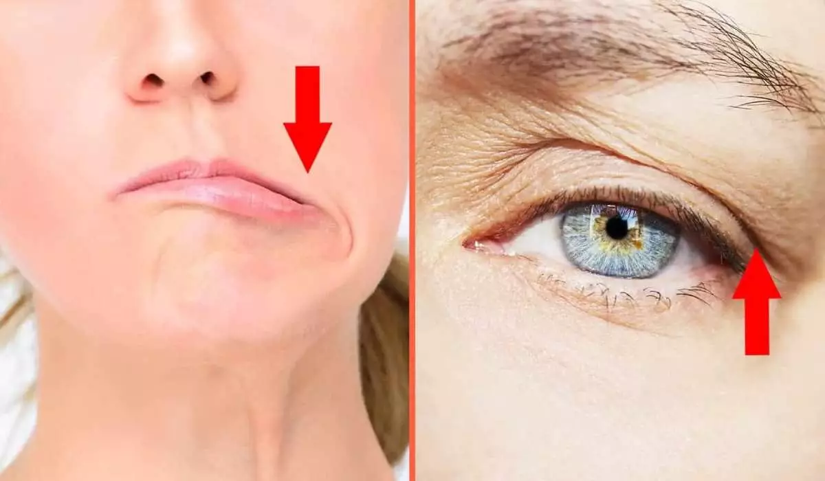 عوارض بوتاکس پیشانی معمولاً خفیف و موقت هستند؛ مانند تورم، قرمزی یا سردرد. در موارد نادر ممکن است افتادگی پلک یا عدم تقارن عضلات رخ دهد. در این مطلب عوارض شایع و نادر بوتاکس پیشانی و راهکارهای کاهش آنها را بررسی کردهایم.