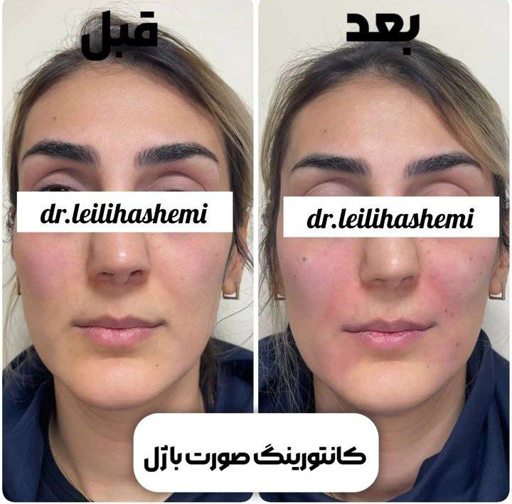 عکس قبل و بعد کانتورینگ صورت با ژل یا عکس قبل و بعد فیلر صورت در کلینیک زیبایی دکتر لیلی هاشمی