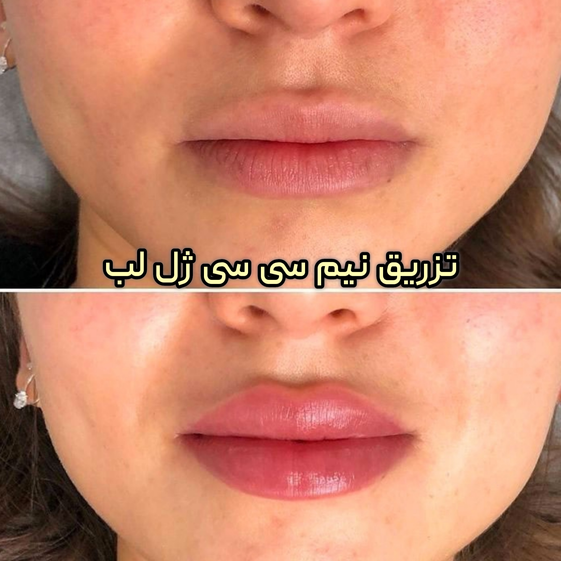 تزریق نیم سی سی ژل لب طبیعی در کلینیک دکتر لیلی هاشمی