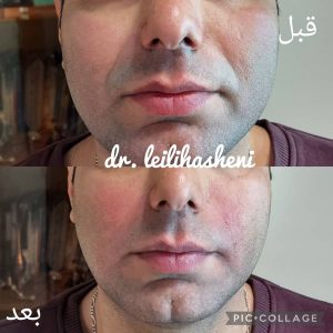 تزریق ژل برای جوانسازی