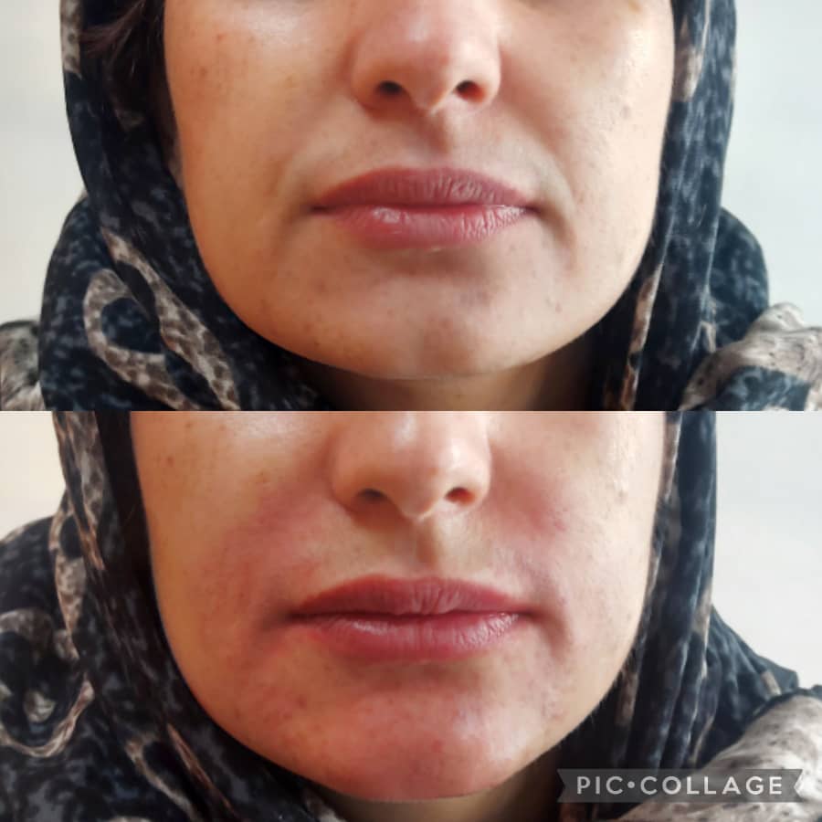 فیلر چانه چیست؟ انواع فیلر چانه + 5 راهکار ماندگاری بیشتر