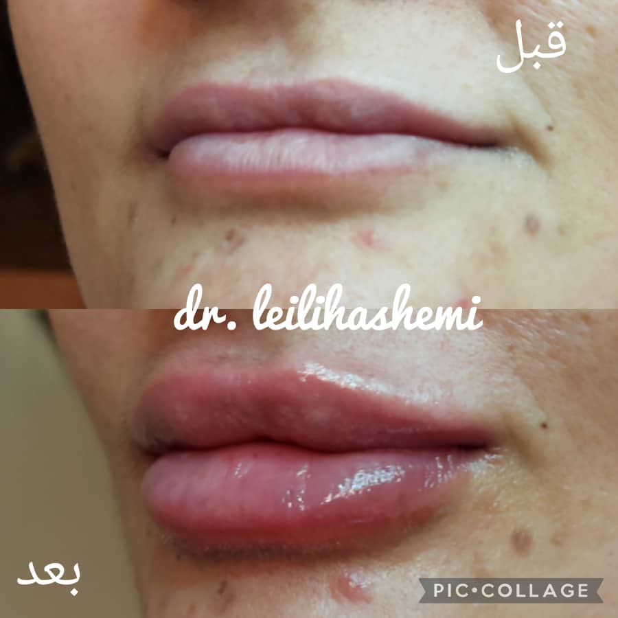 تزریق ژل لب قلوه ای در تهران