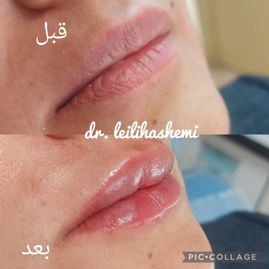 تزریق ژل لب