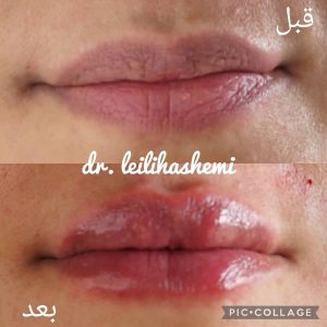 تزریق ژل لب روسی در تهران