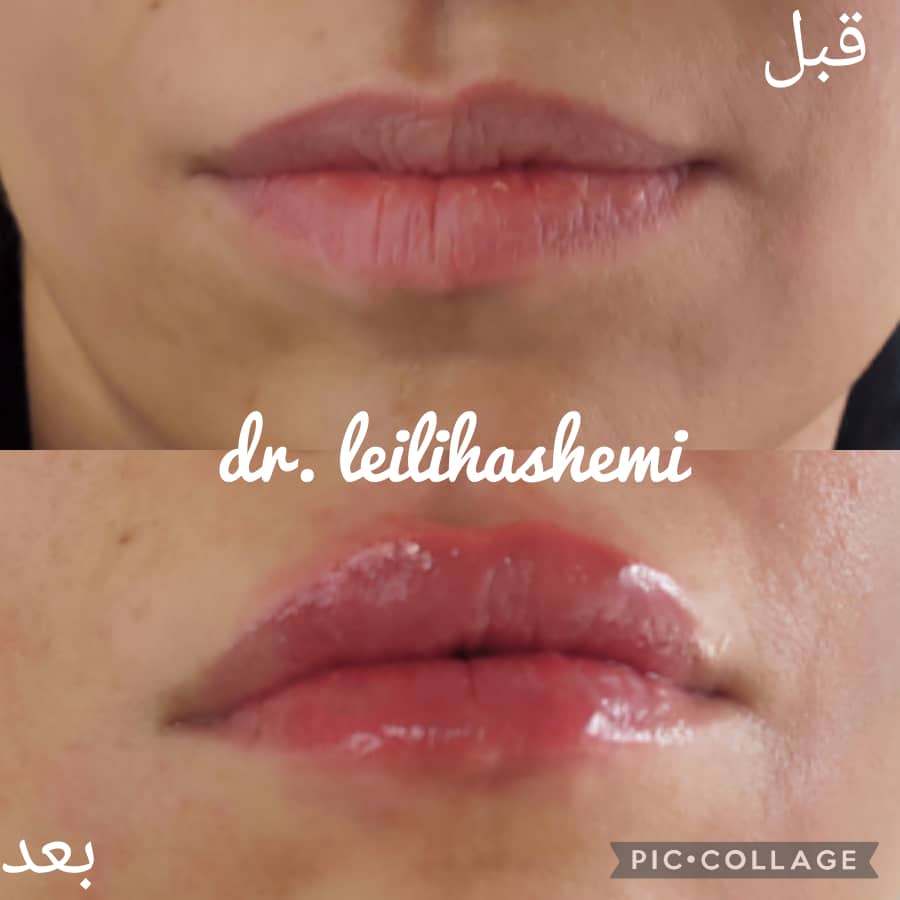 تزریق ژل لب در تهران