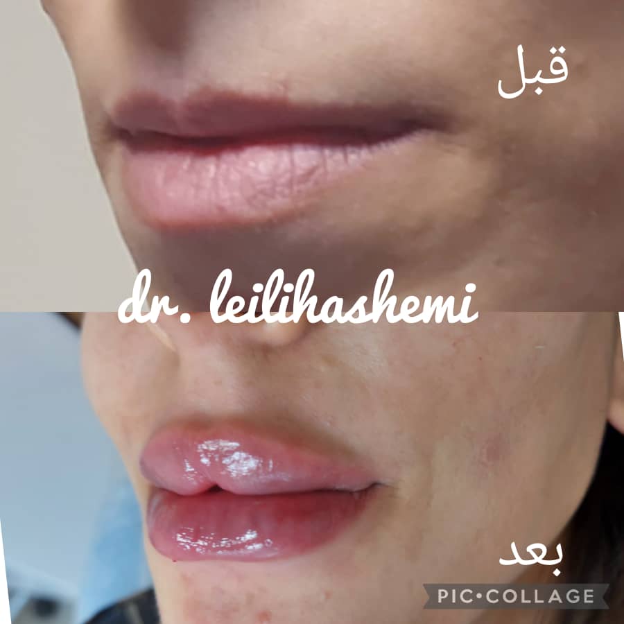 تزریق ژل لب در تهران