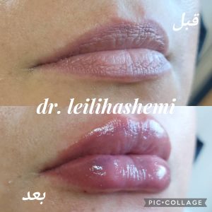 تزریق ژل لب